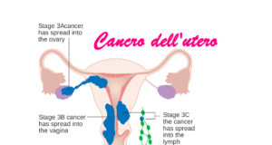 tumore dell'utero