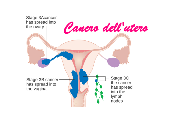 tumore dell'utero