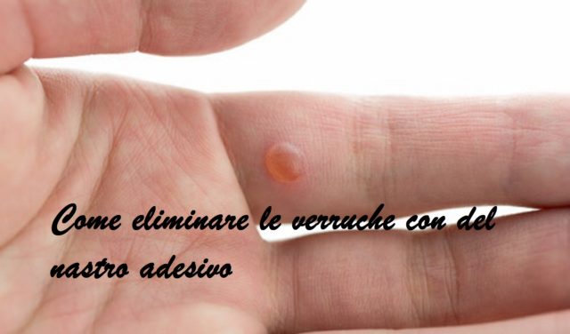 come eliminare le verruche