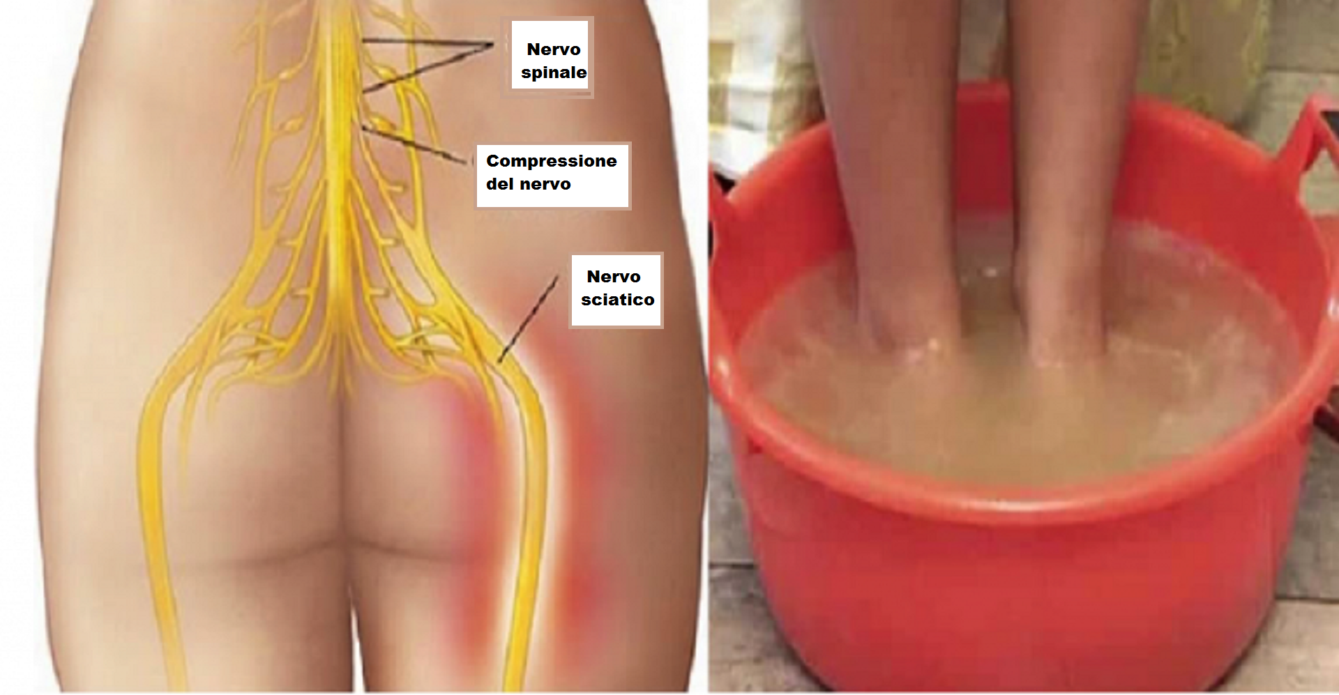 Ишиас воспаление седалищного. Седалищный нерв (sciatic nerve)? 011. Воспаление сежалищногонерва.