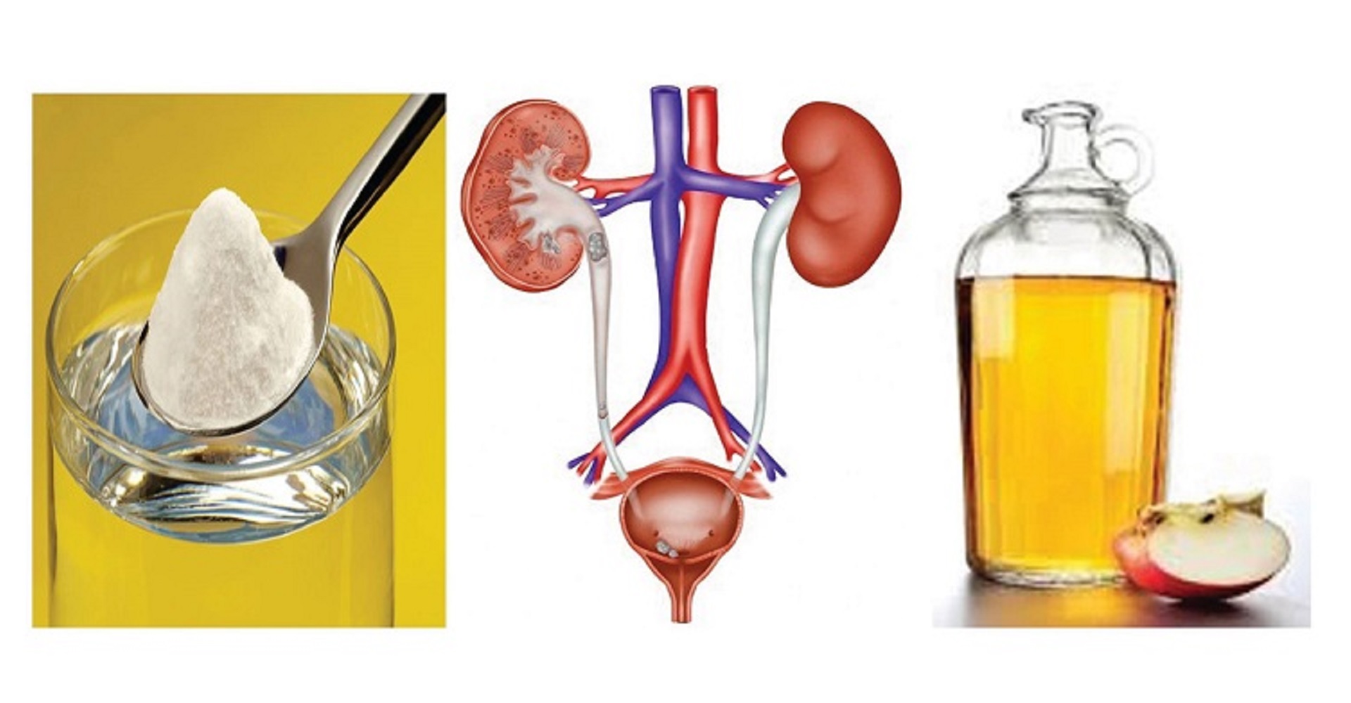 Infezioni urinarie: come eliminarle con bicarbonato e aceto di mele ... Aceto e bicarbonato