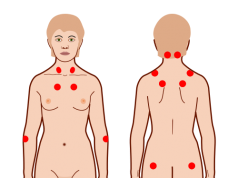 sintomi della fibromialgia