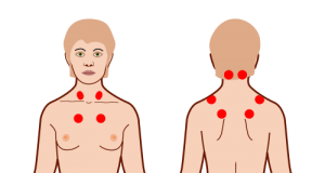 sintomi della fibromialgia