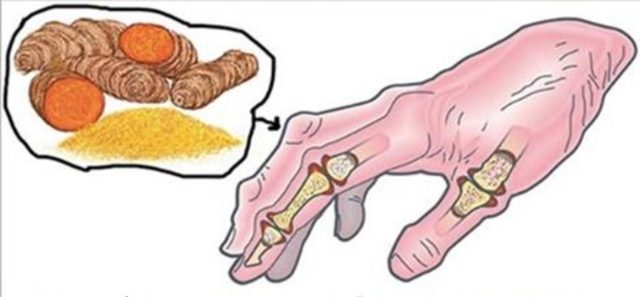 artrite reumatoide