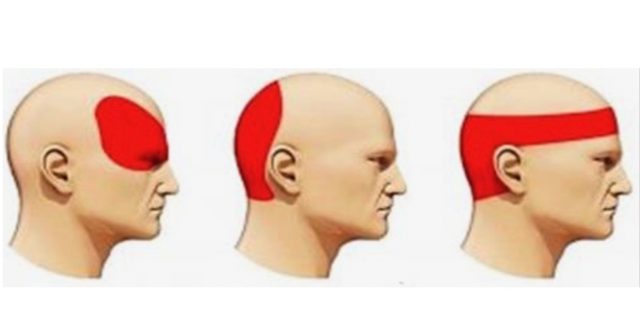 alleviare il mal di testa