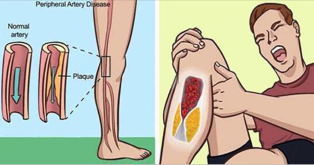 arterie sono ostruite