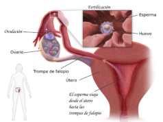 fibroma uterino