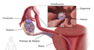 fibroma uterino