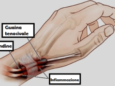 tenosinovite
