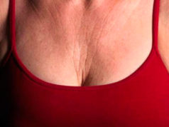 rughe sul collo e sul seno