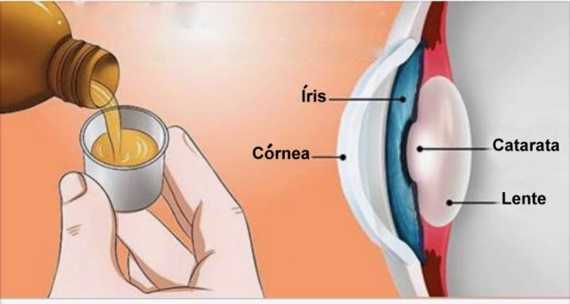 elimina la cataratta