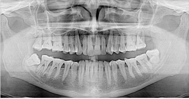 impianti dentali