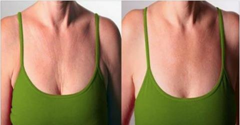 rughe sul seno e sul collo