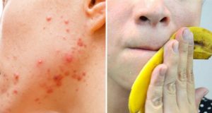 banana per l'acne
