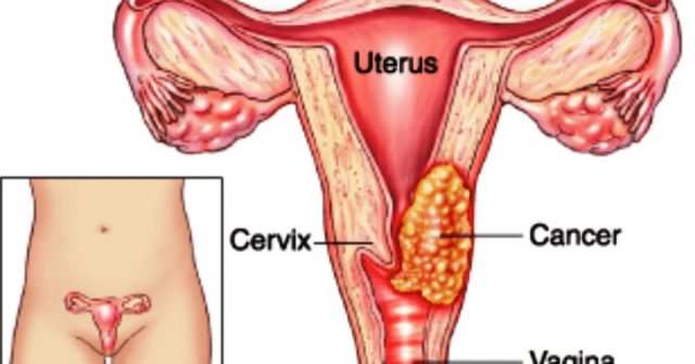 cancro collo utero
