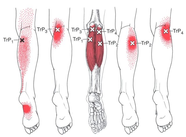 fibromialgia-rimedi